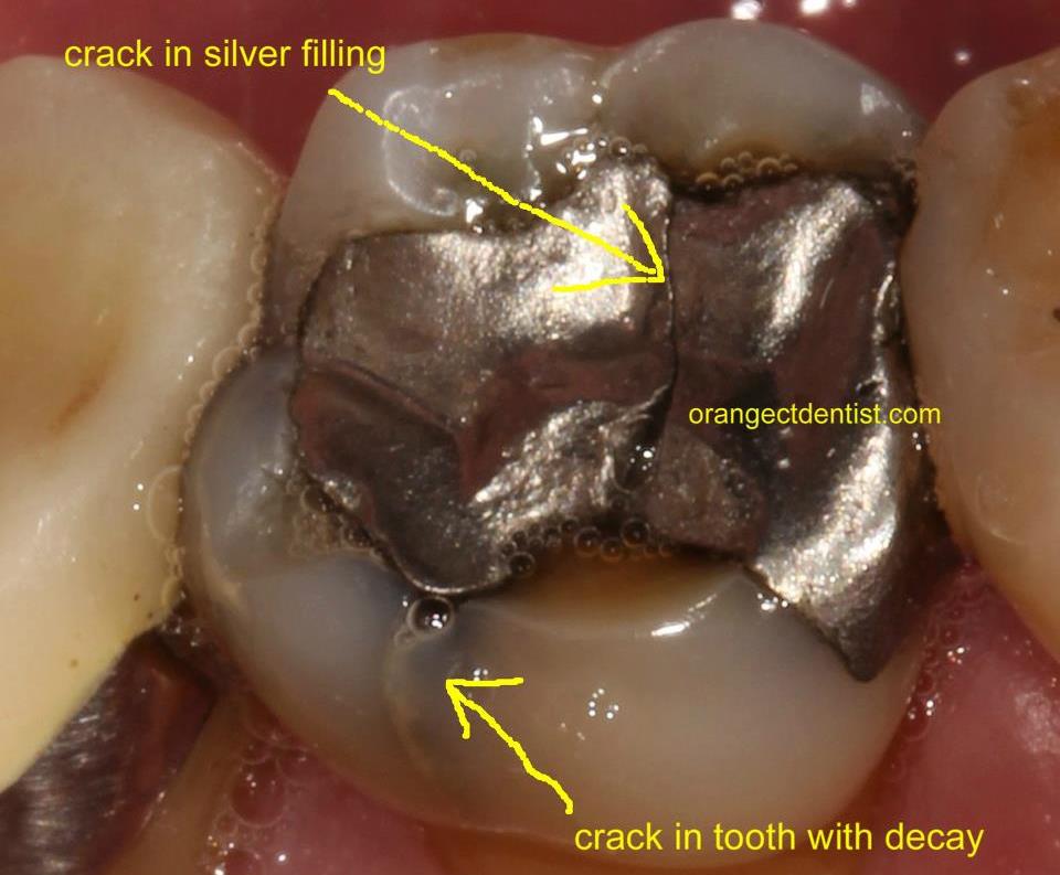 crowns molar fracture calcaterra