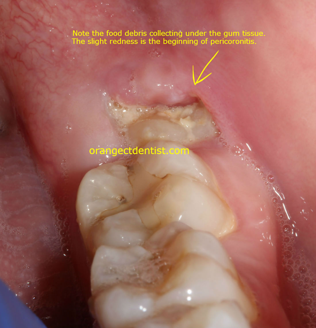 Pericoronitis wisdom tooth dentist