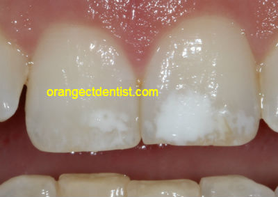 white spots on teeth after fluoride