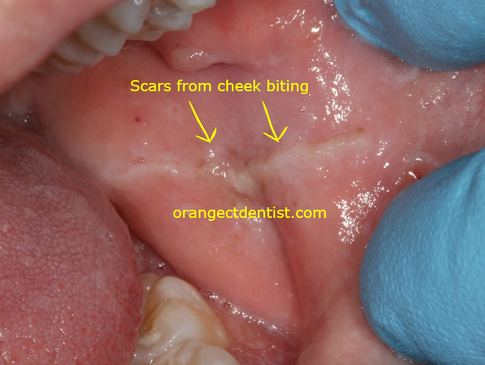 Bitten inside cheek