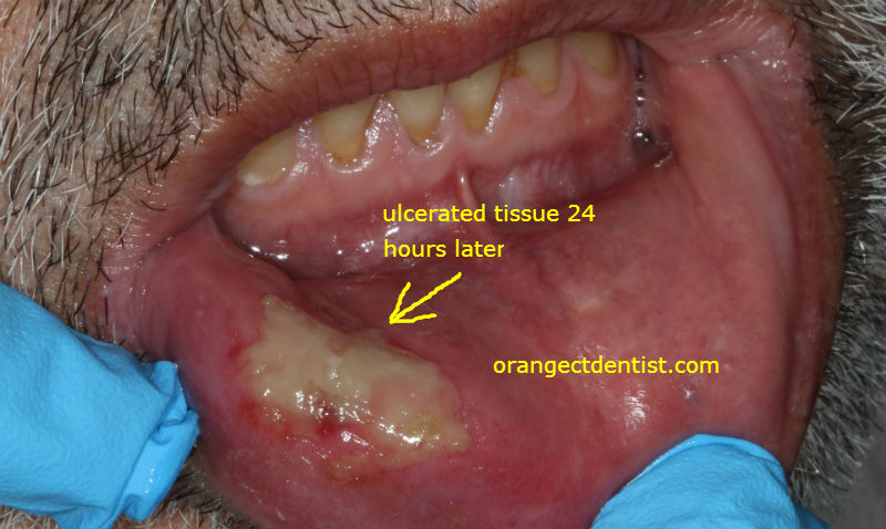 Numbness Mouth Lips 22