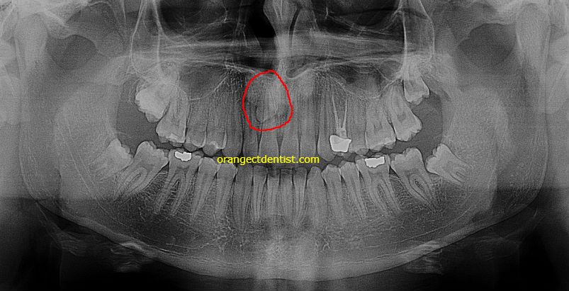 mesiodens supernumerary dentistry