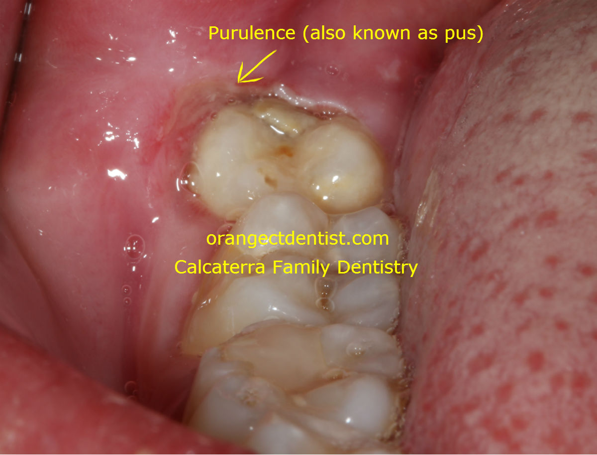 Pericoronitis Wisdom Teeth Dentist Orange West Haven Woodbridge Ct