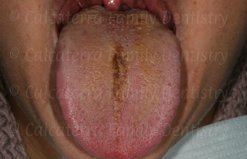Hairy Coated Tongue 92
