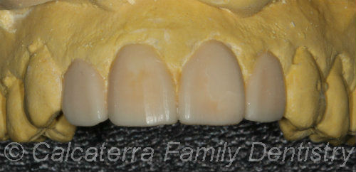 veneers wax mock porcelain teeth veneer dental often