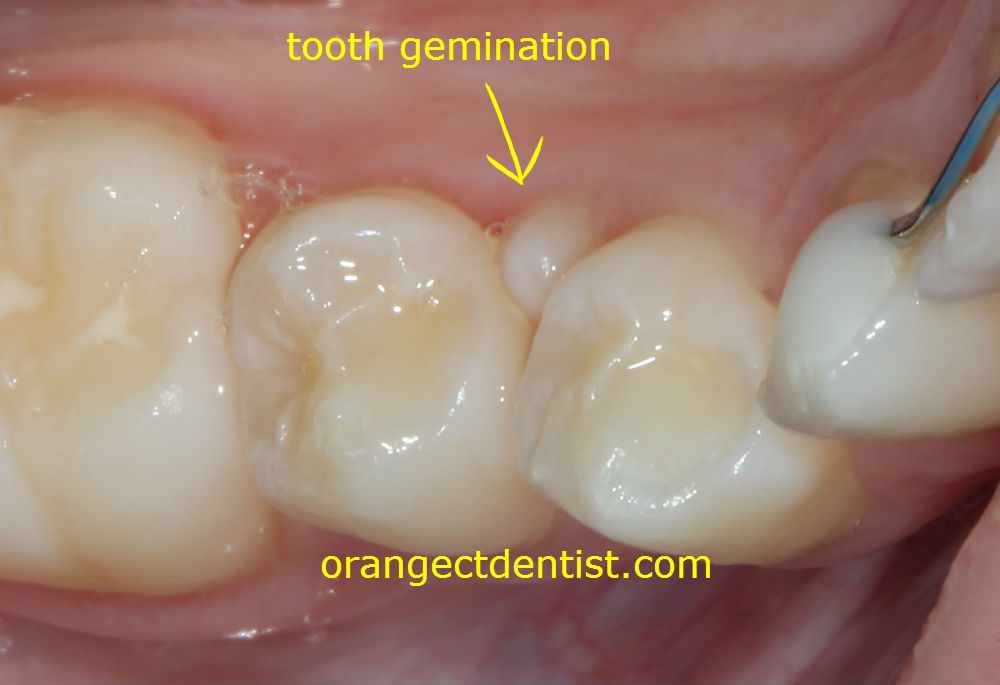 Teeth Gemination | Fusion | Calcaterra Family Dentistry